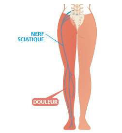 Sciatalgie: symptômes, causes et traitements | PhysioExtra