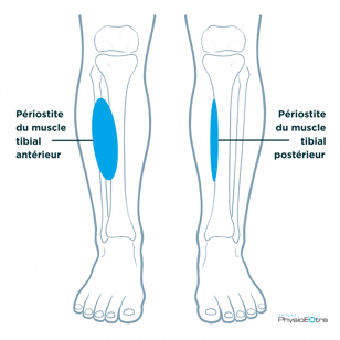 periostite-anterieur-posterieur-physioextra