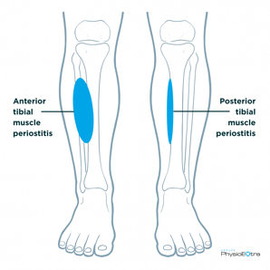 shin-splint-anterior-posterior-physioextra